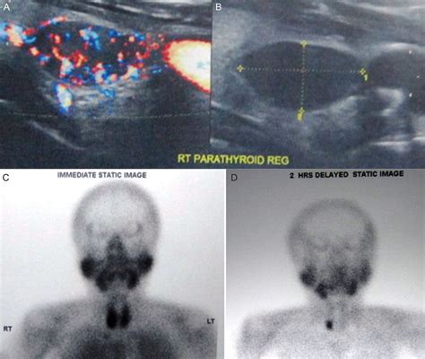 An Interesting Case Of Intrathyroidal Parathyroid Adenoma Bmj Case