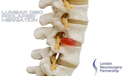 Lumbar Disc Herniation London Neurosurgery Spine