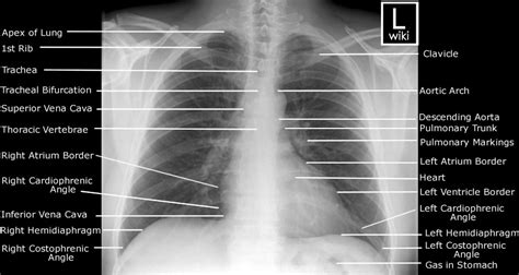 Chest Radiographic Anatomy Wikiradiography