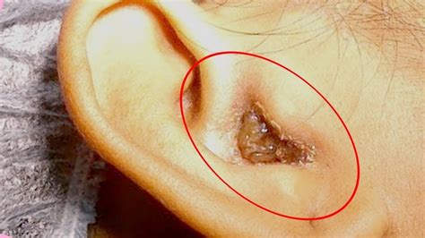 Hearing Loss Due To Massive Earwax Best Earwax Removal Cleaning Your