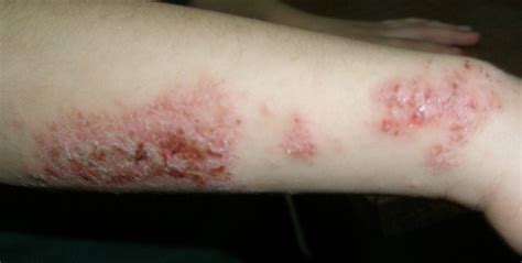 Nummular Dermatitis التهاب الجلد المدنر أو الاكزيمة المدنرة
