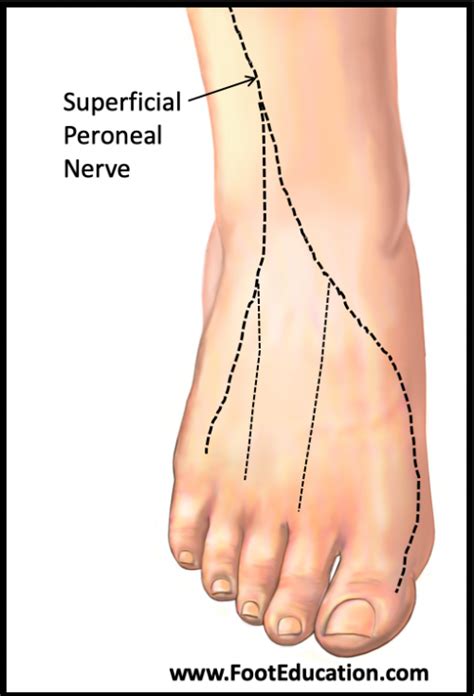 Abnormalities Of The Superficial Peroneal Nerve At The Ankle My Xxx