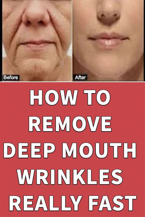 How To Remove Deep Mouth Wrinkles Really Fast Mouth Wrinkles Wrinkles Remedies Face Skin