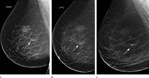 Another way mammograms induce cancer growth is by compressing the patient's breasts. DBT-Reduces-Breast-Biopsy-Rates