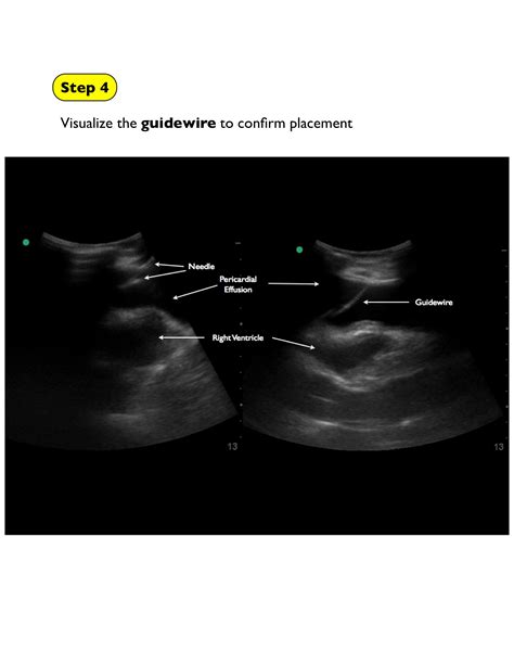 Lumbar Puncture And Pericardiocentesis — Highland Em Ultrasound Fueled