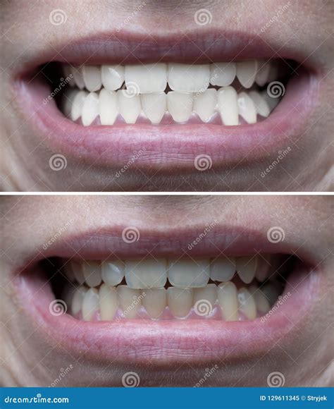 Teeth Whitening Before After Stock Image Image Of Clear Dental