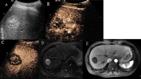 Hepatic Hemangioma With No Enhancement In All Vascular Phases A