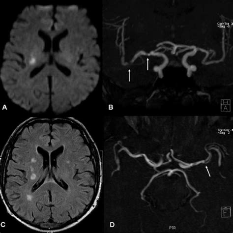 Brain Mri And Mri Angiography Download Scientific Diagram