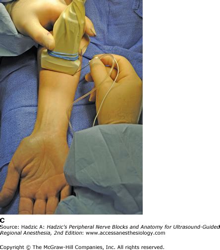 Chapter 33 Ultrasound Guided Forearm Blocks Hadzics Peripheral