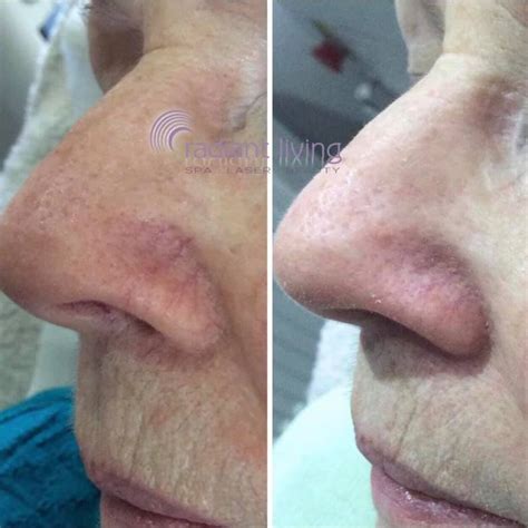 Fed Up With Red Face Veins Thread Veins Or Rosacea Call Radiant Living