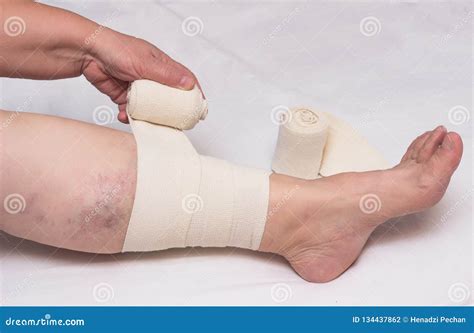 Woman Bandages Leg With Elastic Bandage Against Varicose Veins On Legs