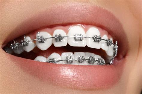 Show Off Your Smile Braces Level Orthodontics