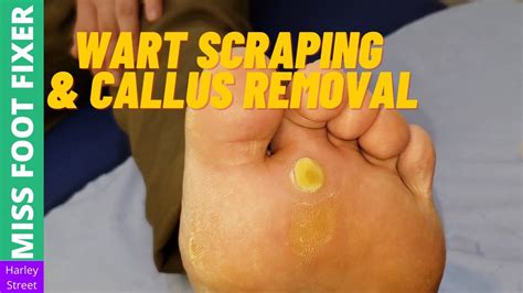 Wart Scraping And Bottom Callus Removal Miss Foot Fixer Youtube