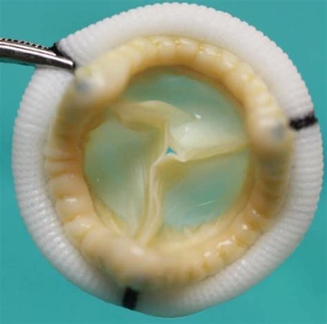 Heart Valve Prosthesis Replacement Of Diseased Valves With Prosthetic