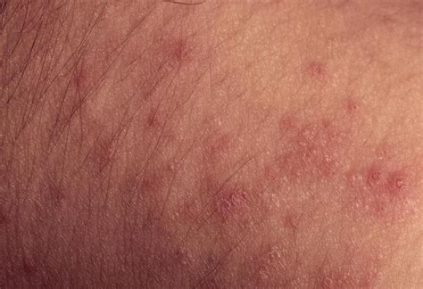 How Can I Treat Bed Bug Rashes With Pictures