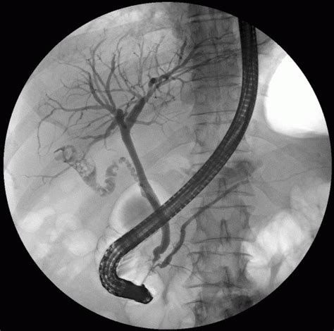 Biliary Strictures Bile Duct Narrowing