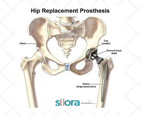 Pin On Hip Prosthesis Manufacturer Hip Implants Manufacturers