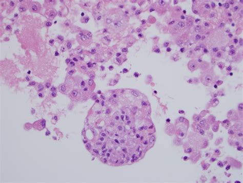 The Diagnosis Of Malignant Mesothelioma In Effusion Cytology Paintal