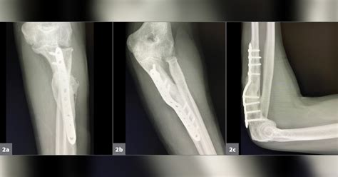 A 39 Year Old Man With A Chronic Monteggia Fracture Dislocation