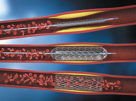 The Story On Heart Stents Harvard Health