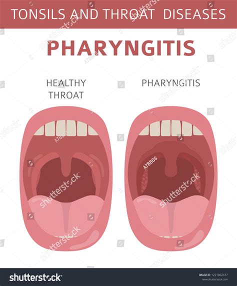 Tonsils Throat Diseases Pharyngitis Symptoms Treatment Stock Vector