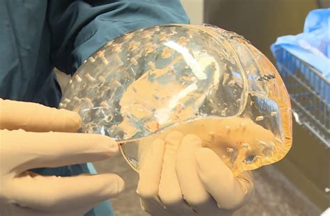 Take A Look At The First Successfully Transplanted 3d Printed Skull