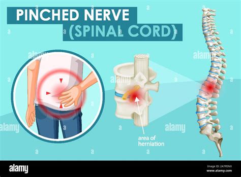Diagram Showing Pinched Nerve In Human Illustration Stock Vector Image