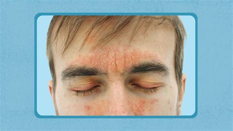 Psoriasis On The Face Facial Psoriasis