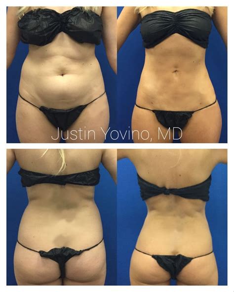 Supersculpting Liposuction Of The Abdomen Flanks Love Handles And