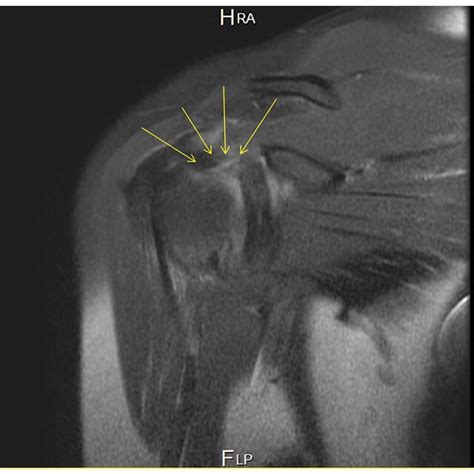 Magnetic Resonance Imaging Of The Left Shoulder Showing Synovial