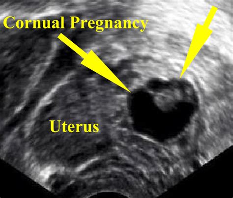 Successful Management Of Cornual Ectopic Pregnancy With Laparoscopy