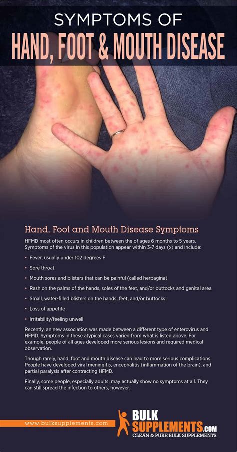 Do You Know The Symptoms Of Hand Foot And Mouth Disease Check Out Our