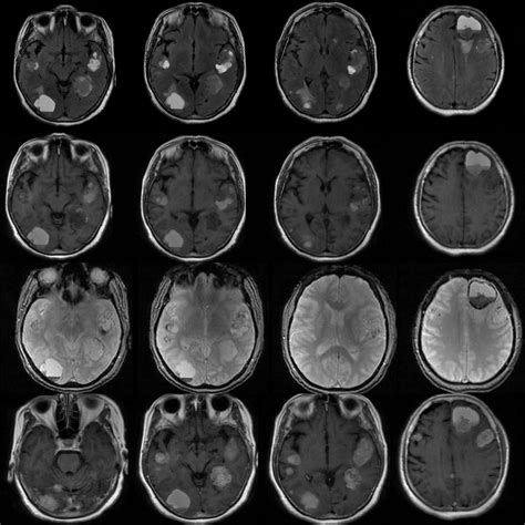 Mri Images Of Brain Metastases Mri Mri Scan Radiography