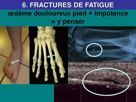 ostéopathie pied éliminer fracture fatigue Adhésiolyse Manuelle