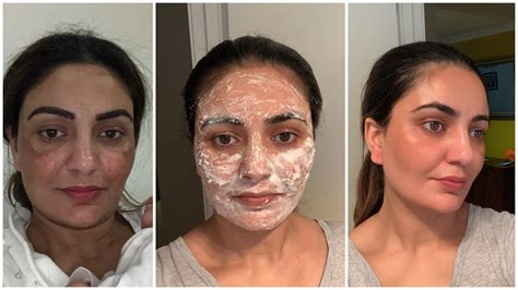 How I Treated My Hyperpigmentationdark Spotsmelasma On Face Punjabi