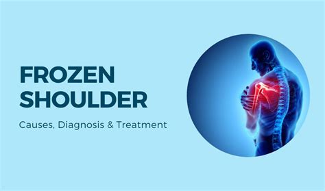 Frozen Shoulder Causes Diagnosis And Treatment