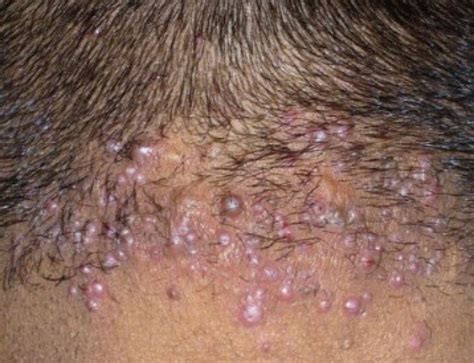 Pimples On Back Of Head Under Hair And Neck After Haircut Hurts