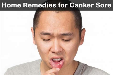 21 Diy Home Remedies For Canker Sore