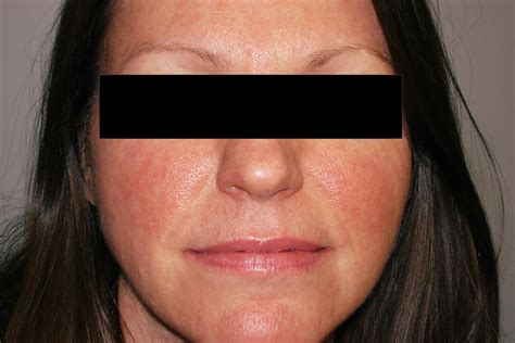 Leading Dermatologists Urge Greater Focus On Facial Redness At Nrs