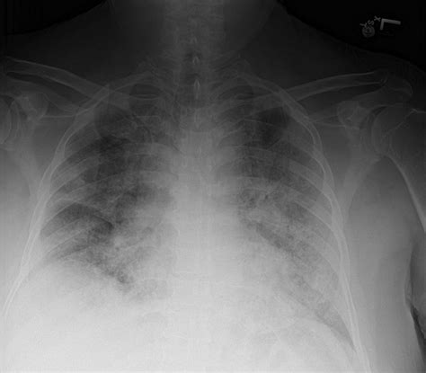 Chest X Ray Showing Mild Cardiomegaly And Bilateral Hazy Infiltrates