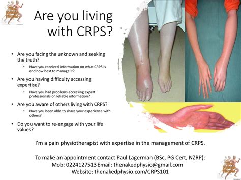 Are You Or Someone You Know Living With CRPS Are You In The Auckland