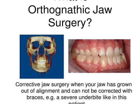 Ppt Orthognathic Jaw Surgery And Bimaxillary Sleep Surgery Powerpoint