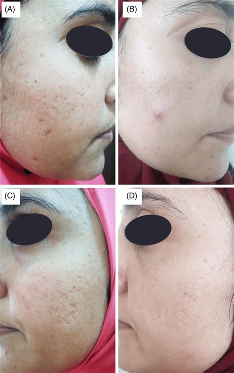 A 30‐year‐old Female Presented With Moderate Post‐acne Scars Grade 3