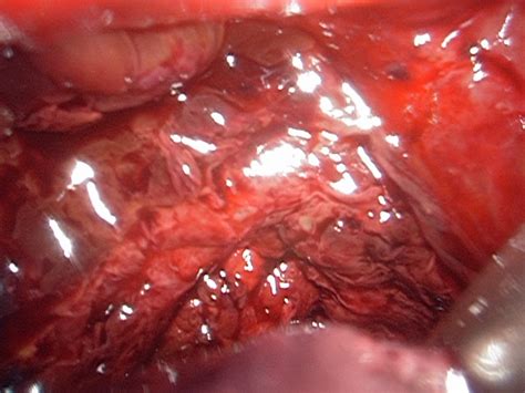 Currently it is not known what causes endometriosis. Endometriosis