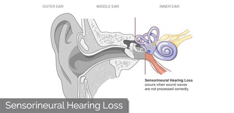 Approximately half of the cases of congenital snhl have a nonhereditary basis, and in roughly half of these, an underlying environmental cause can be identified. What is sensorineural hearing loss?