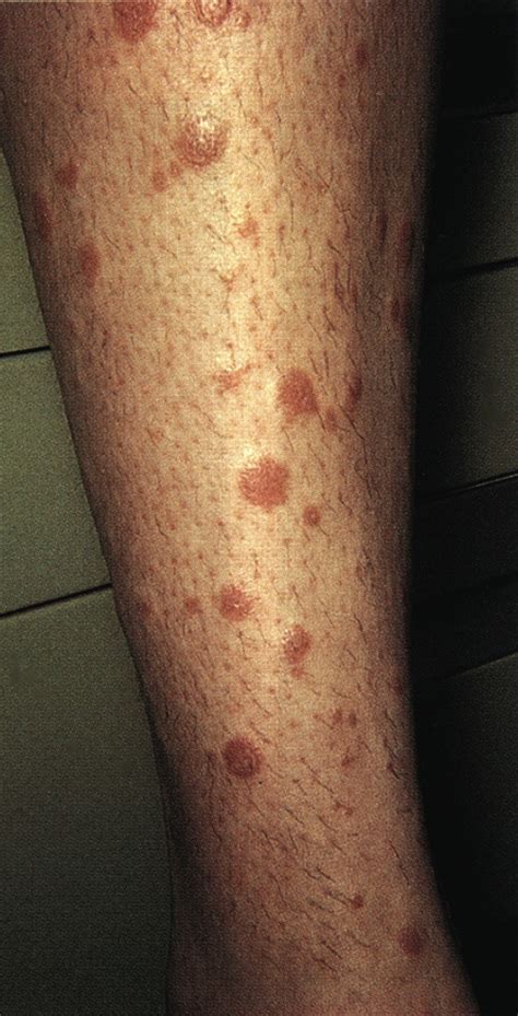 Lichen Sclerosus On Legs
