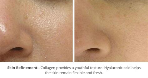 Hydrafacial Before And After Photos London Premier Laser And Skin Clinic