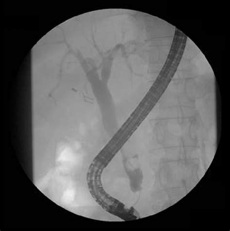 Endoscopic Retrograde Cholangiography Showing Dilatation Of The Common