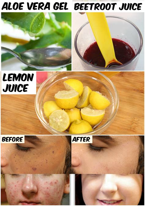 Pin On Acne Scars How To Get Rid Of
