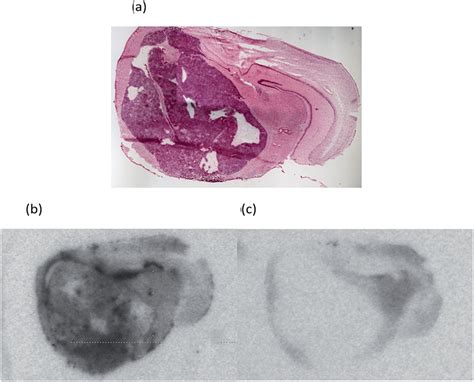 A H E Stained Section Of A Cd Nude Mouse Brain Bearing An Orthotopic